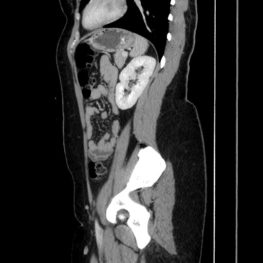 File:Acute uncomplicated appendicitis (Radiopaedia 73704-84499 Sagittal C+ portal venous phase 142).jpg