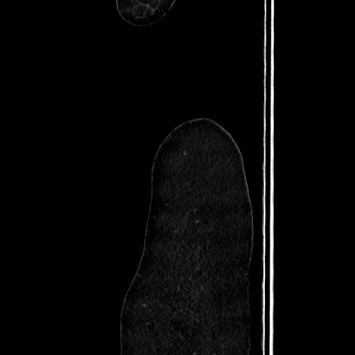 File:Acute uncomplicated appendicitis (Radiopaedia 73704-84499 Sagittal C+ portal venous phase 23).jpg