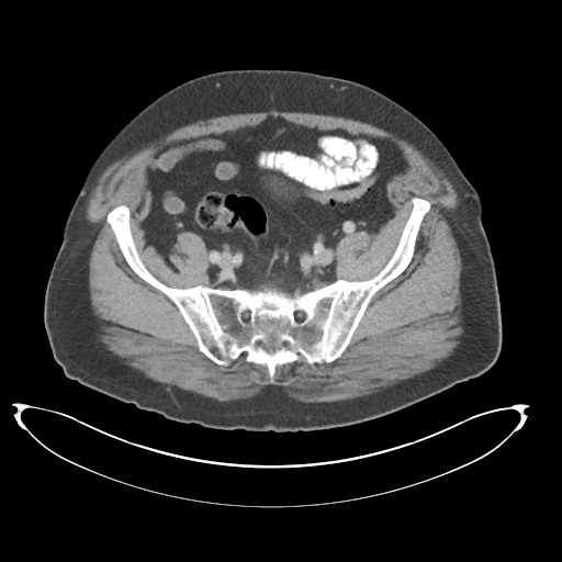 Adenocarcioma of rectum- T1 lesion (Radiopaedia 36921-38547 Axial C+ portal venous phase 69).png