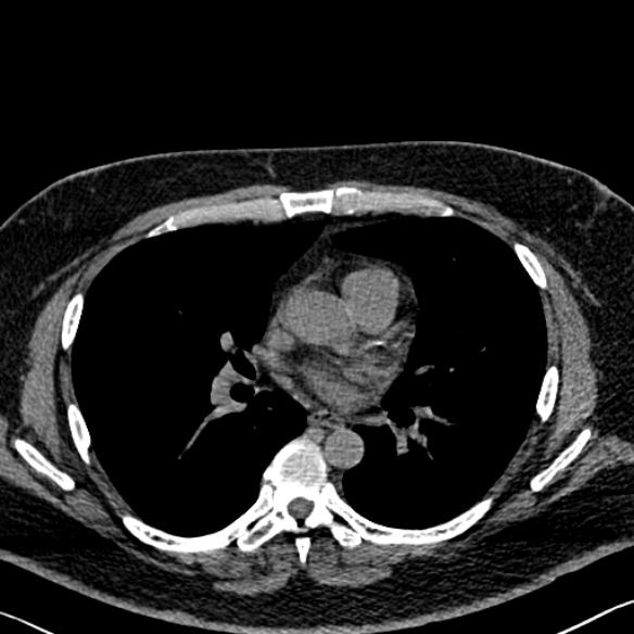 File:Adenoid cystic carcinoma of the trachea (Radiopaedia 49042-54137 Axial non-contrast 181).jpg