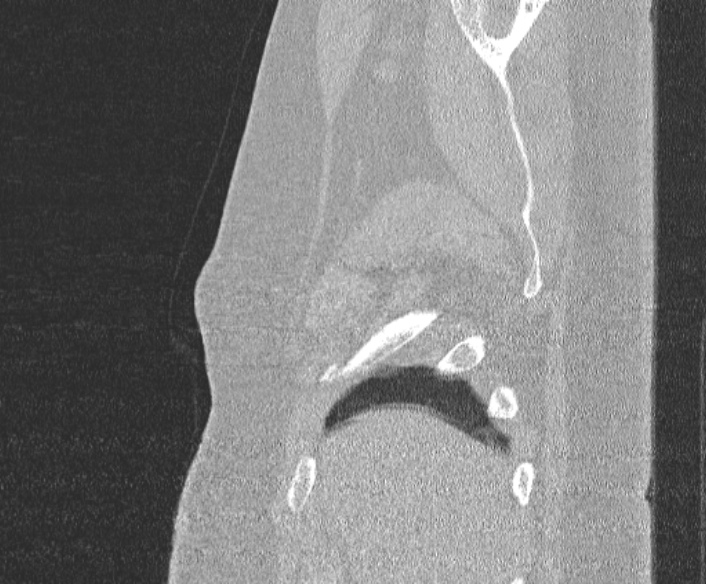 Adenoid cystic carcinoma of the trachea (Radiopaedia 49042-54137 Sagittal lung window 38).jpg