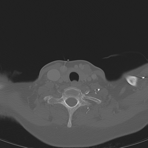 Adenoid cystic tumor of palate (Radiopaedia 46980-51518 Axial bone window 60).png