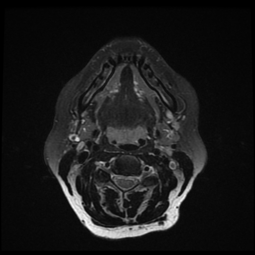 File:Adenoid cystic tumor of palate (Radiopaedia 46980-51519 Axial T2 fat sat 13).png