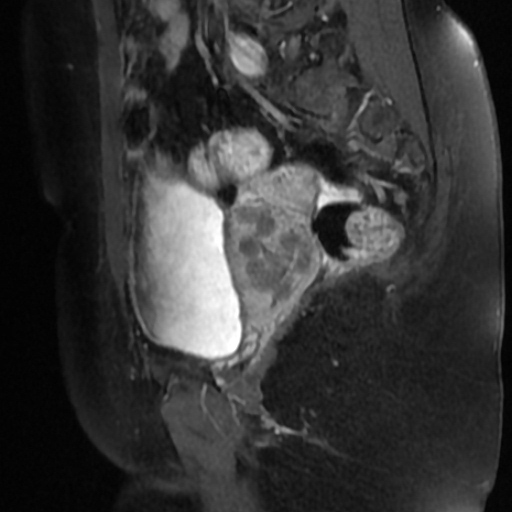 File:Adenoma malignum of cervix (Radiopaedia 66441-75705 Sagittal T1 C+ fat sat 15).jpg