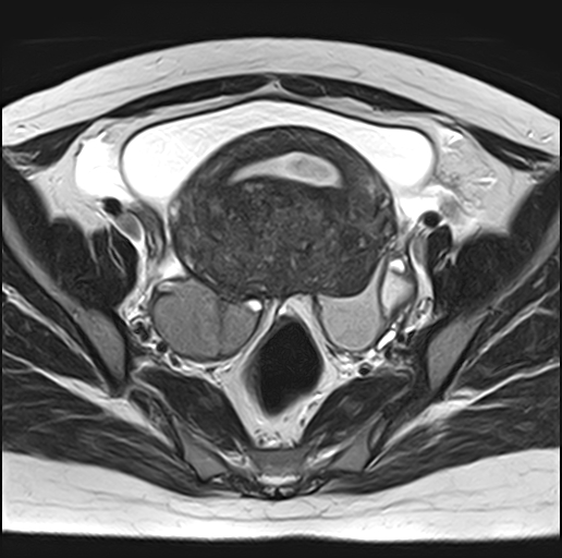 File:Adenomyosis - ovarian endometriomas (Radiopaedia 67031-76350 Axial T2 13).jpg