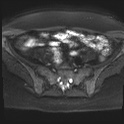 File:Adenomyosis and endometriotic cysts (Radiopaedia 82300-96367 Axial DWI 20).jpg