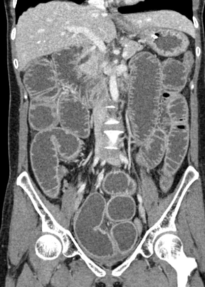 Adhesional small bowel obstruction (Radiopaedia 48397-53305 Coronal C+ portal venous phase 171).jpg