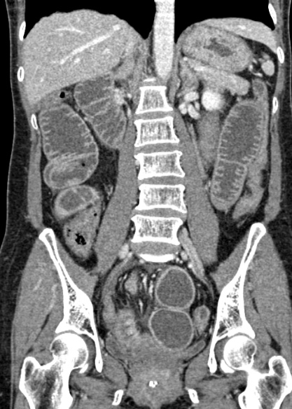 Adhesional small bowel obstruction (Radiopaedia 48397-53305 Coronal C+ portal venous phase 207).jpg