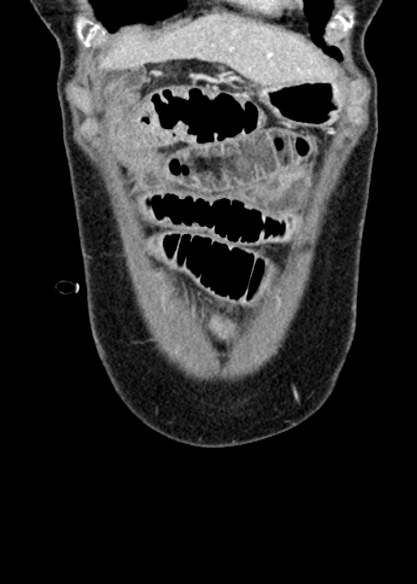 Adhesional small bowel obstruction (Radiopaedia 48397-53305 Coronal C+ portal venous phase 54).jpg