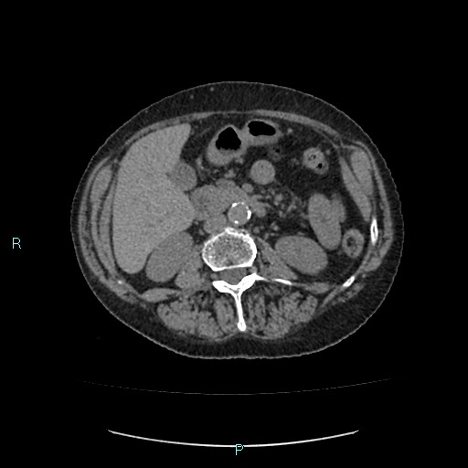 File:Adrenal collision tumor (ACT) (Radiopaedia 48462-53379 Axial non-contrast 27).jpg