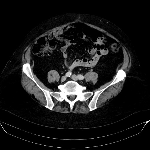 Adrenal cortical carcinoma (Radiopaedia 64017-72769 Axial C+ portal venous phase 51).jpg