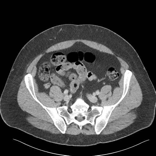 Adrenal cyst (Radiopaedia 45625-49777 Axial C+ portal venous phase 76).png