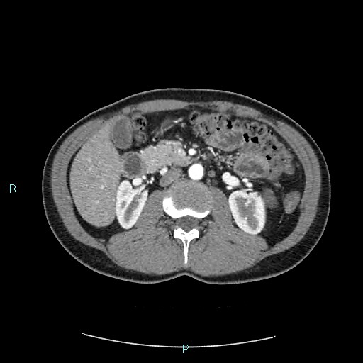 Adrenal cystic lymphangioma (Radiopaedia 83161-97534 Axial C+ arterial phase 40).jpg
