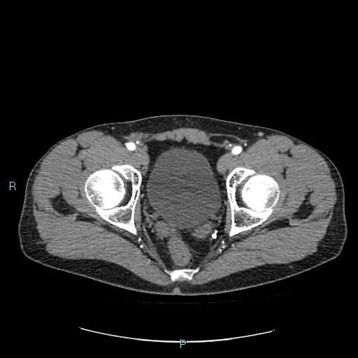 Adrenal cystic lymphangioma (Radiopaedia 83161-97534 Axial C+ arterial phase 92).jpg