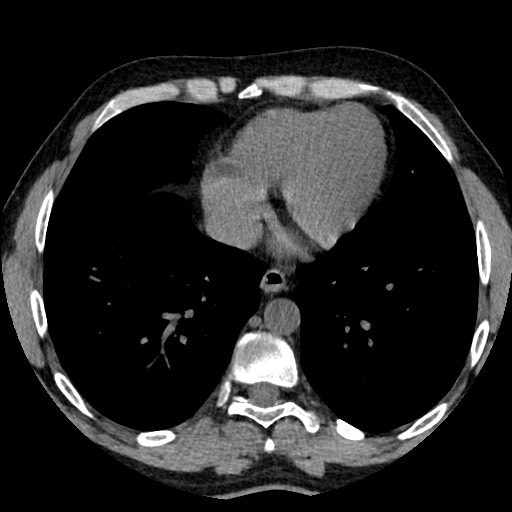 File:Adrenal gland trauma (Radiopaedia 81351-95079 Axial non-contrast 2).jpg