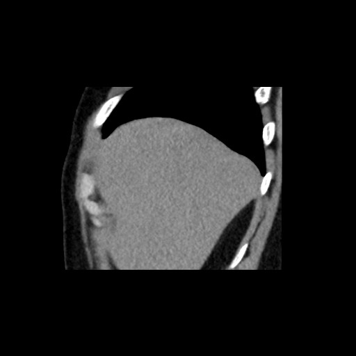 Adrenal gland trauma (Radiopaedia 81351-95079 Sagittal non-contrast 13).jpg