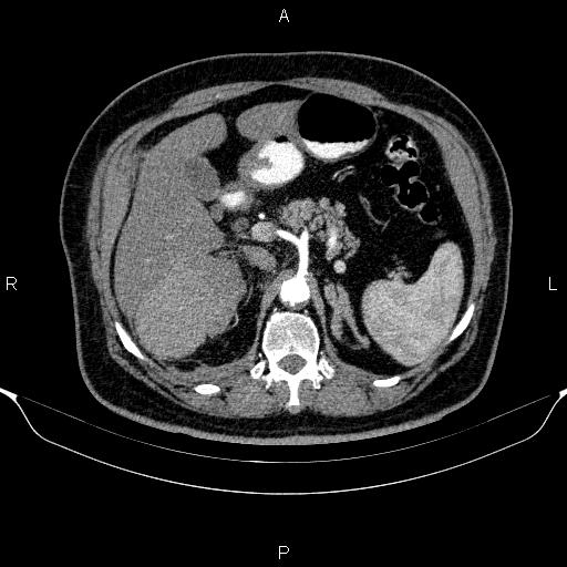 Adrenal hemorrhage (Radiopaedia 62622-70916 Axial C+ arterial phase 117).jpg