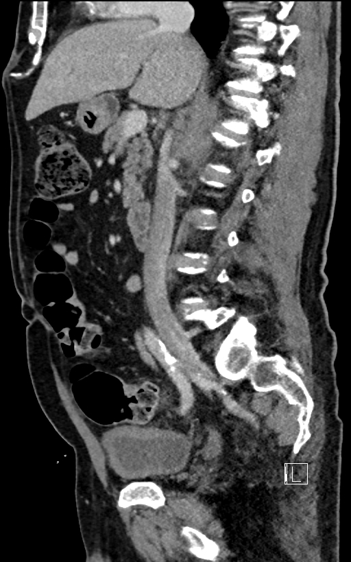Adrenal lymphoma (Radiopaedia 73730-84529 Sagittal C+ portal venous phase 51).jpg