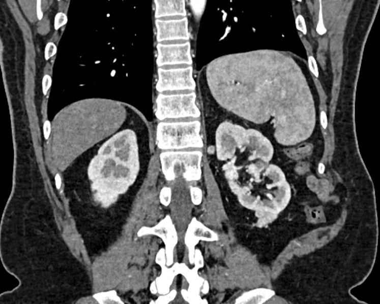 Adrenal metastases (Radiopaedia 73082-83791 Coronal C+ arterial phase 59).jpg