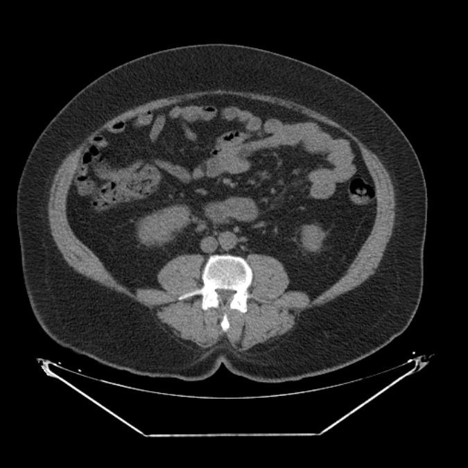 Adrenal myelolipoma (Radiopaedia 26278-26407 Axial non-contrast 39).jpg