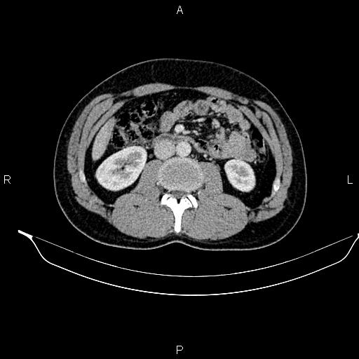 File:Adrenal myelolipoma (Radiopaedia 87794-104246 Axial renal cortical phase 52).jpg