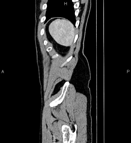 Adrenal myelolipoma (Radiopaedia 87794-104246 Sagittal renal cortical phase 88).jpg