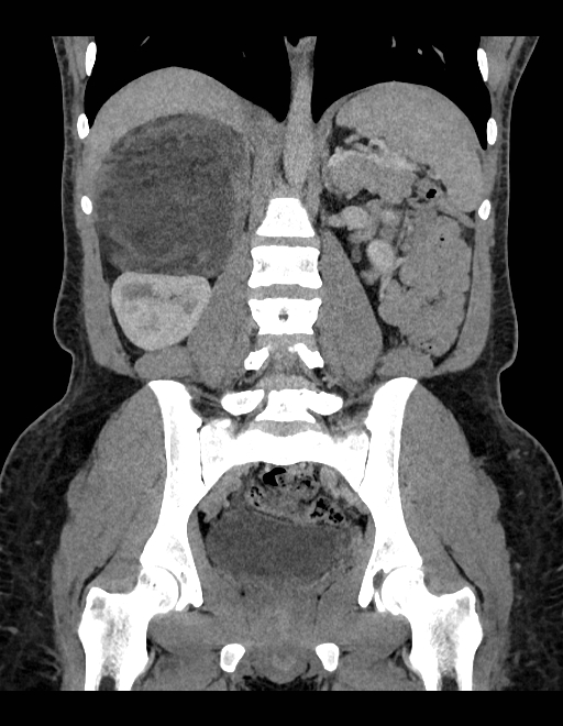 Adrenal myelolipoma - bilateral (Radiopaedia 74805-85810 Coronal C+ portal venous phase 129).jpg