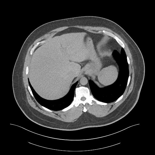 File:Adrenal vein sampling and adrenal nodular hyperplasia - Conn syndrome (Radiopaedia 30561-31337 Axial non-contrast 9).jpg