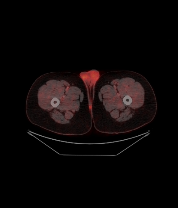 Adrenocortical carcinoma (Radiopaedia 80134-93440 ِAxial 283).jpg