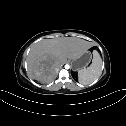 Adrenocortical carcinoma (Radiopaedia 87281-103569 Axial C+ arterial phase 19).jpg