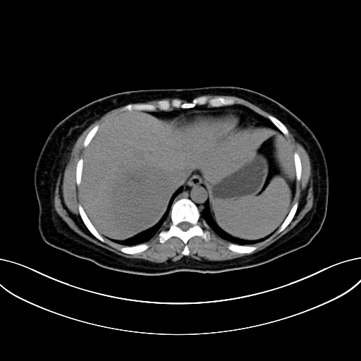 Adrenocortical carcinoma (Radiopaedia 87281-103569 Axial non-contrast 15).jpg