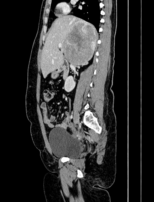 Adrenocortical carcinoma (Radiopaedia 87281-103569 Sagittal C+ portal venous phase 109).jpg
