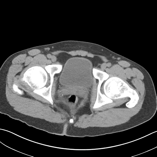 File:Adult polycystic kidney disease (Radiopaedia 47866-52626 Axial non-contrast 82).png