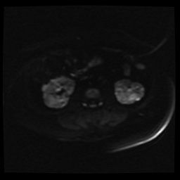 Adult polycystic kidney disease (Radiopaedia 59075-66365 Axial DWI 11).jpg