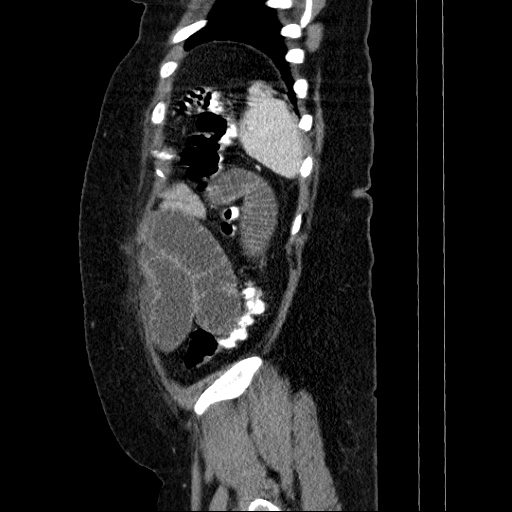 Afferent loop syndrome - secondary to incarcerated trocar site hernia (Radiopaedia 82959-97305 Sagittal C+ portal venous phase 22).jpg