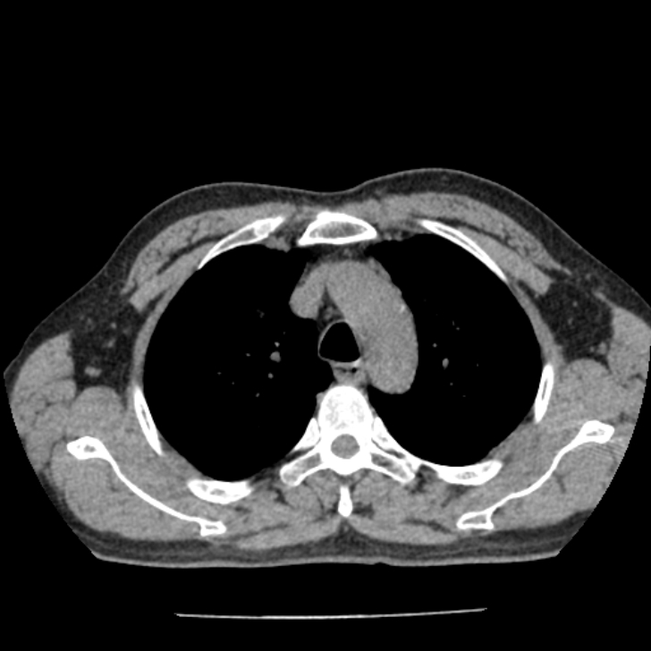 Airway foreign body in adult (Radiopaedia 85907-101779 Axial liver window 33).jpg