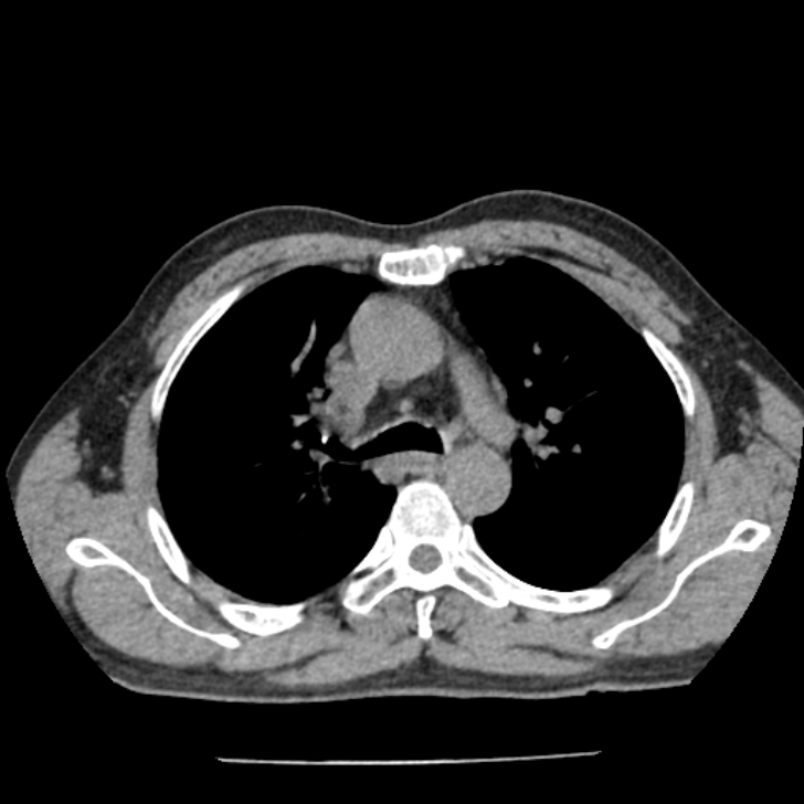 Airway foreign body in adult (Radiopaedia 85907-101779 Axial liver window 53).jpg