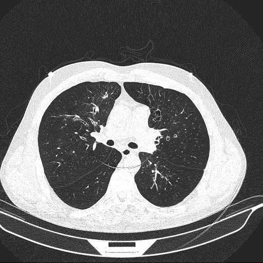 File:Allergic bronchopulmonary aspergillosis (Radiopaedia 21386-21320 Axial lung window 16).jpg