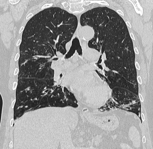 Alpha-1-antitrypsin deficiency (Radiopaedia 72058-82557 Coronal lung window 43).jpg