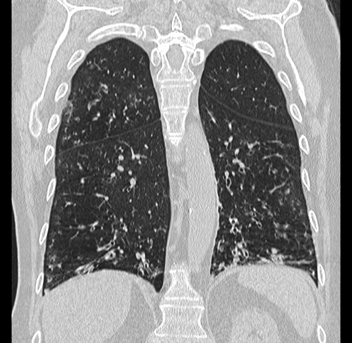Alpha-1-antitrypsin deficiency (Radiopaedia 72058-82557 Coronal lung window 70).jpg