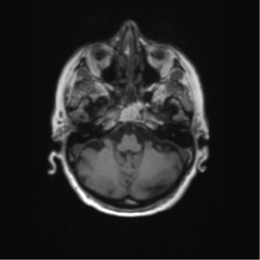 File:Alzheimer's disease (Radiopaedia 42658-45802 Axial T1 120).png