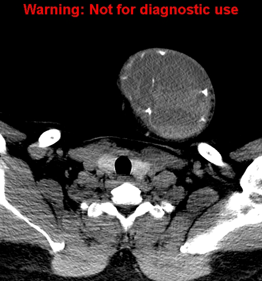 File:Ameloblastoma (Radiopaedia 33126-34164 A 36).jpg