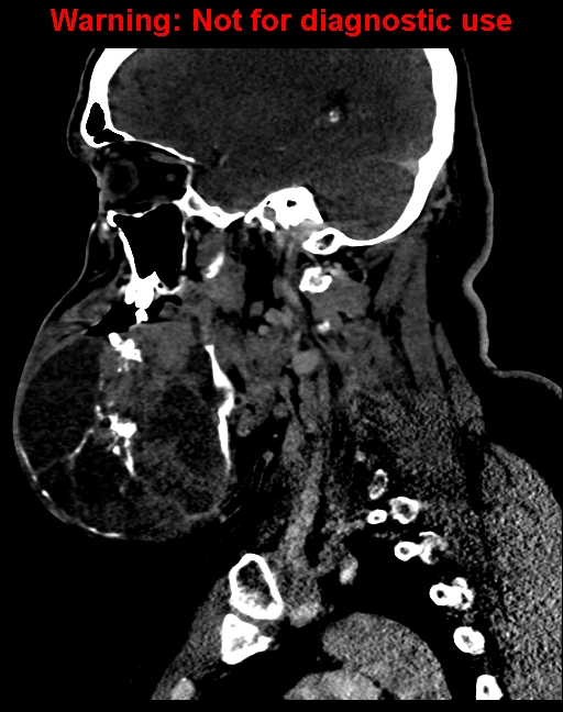 Ameloblastoma (Radiopaedia 33126-34164 F 27).jpg