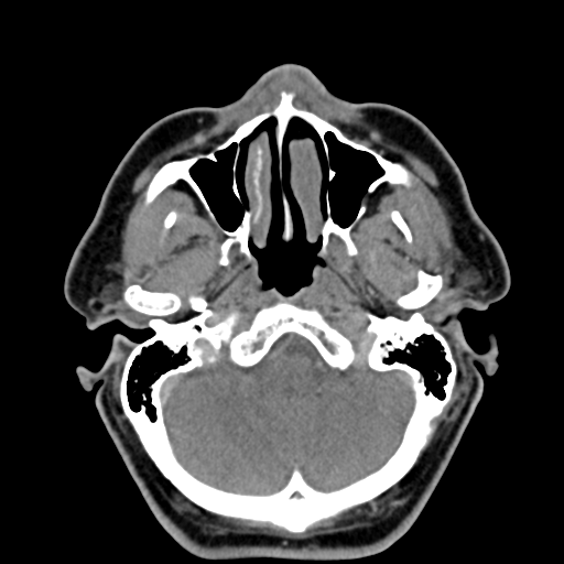 Ameloblastoma (Radiopaedia 38520-40623 Axial non-contrast 16).png