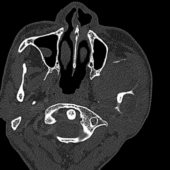 Ameloblastoma (Radiopaedia 51921-57766 Axial bone window 115).jpg