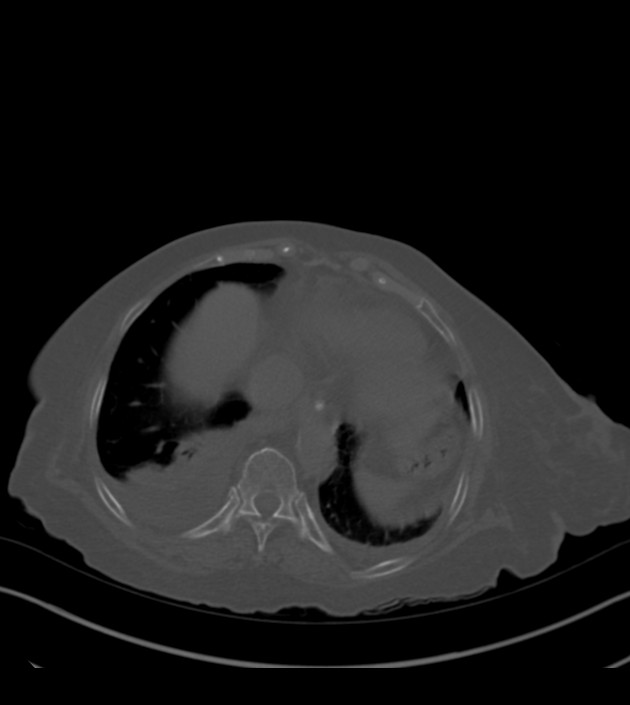 Amiodarone deposition in the liver (Radiopaedia 77587-89780 Axial bone window 65).jpg