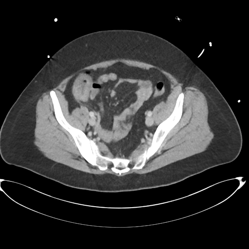 File:Amoebic liver abscess (Radiopaedia 52611-58530 A 79).png