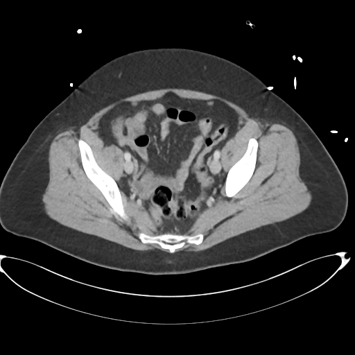 File:Amoebic liver abscess (Radiopaedia 52611-58530 A 82).png
