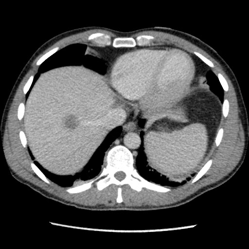 Amoebic liver abscesses (Radiopaedia 55536-62009 A 12).jpg