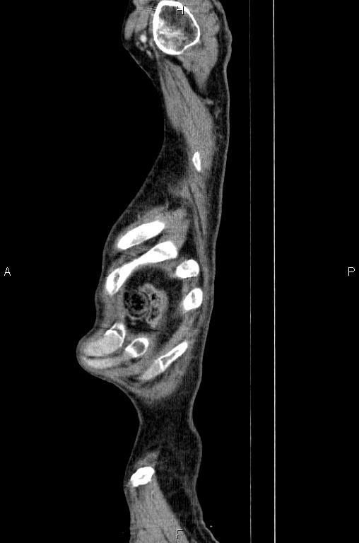 Ampullary adenocarcinoma (Radiopaedia 86093-102033 E 92).jpg